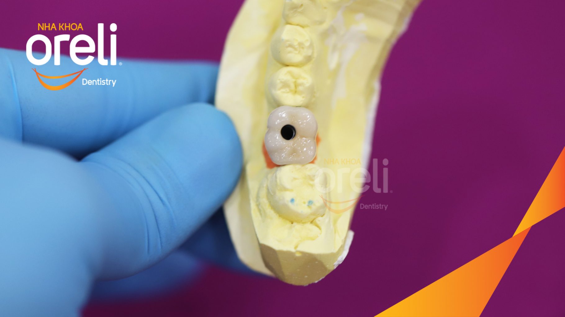 Thực hiện Cấy ghép trụ Implant chính  hãng vào vùng  mất  răng kéo dài 3 tháng tại Oreli