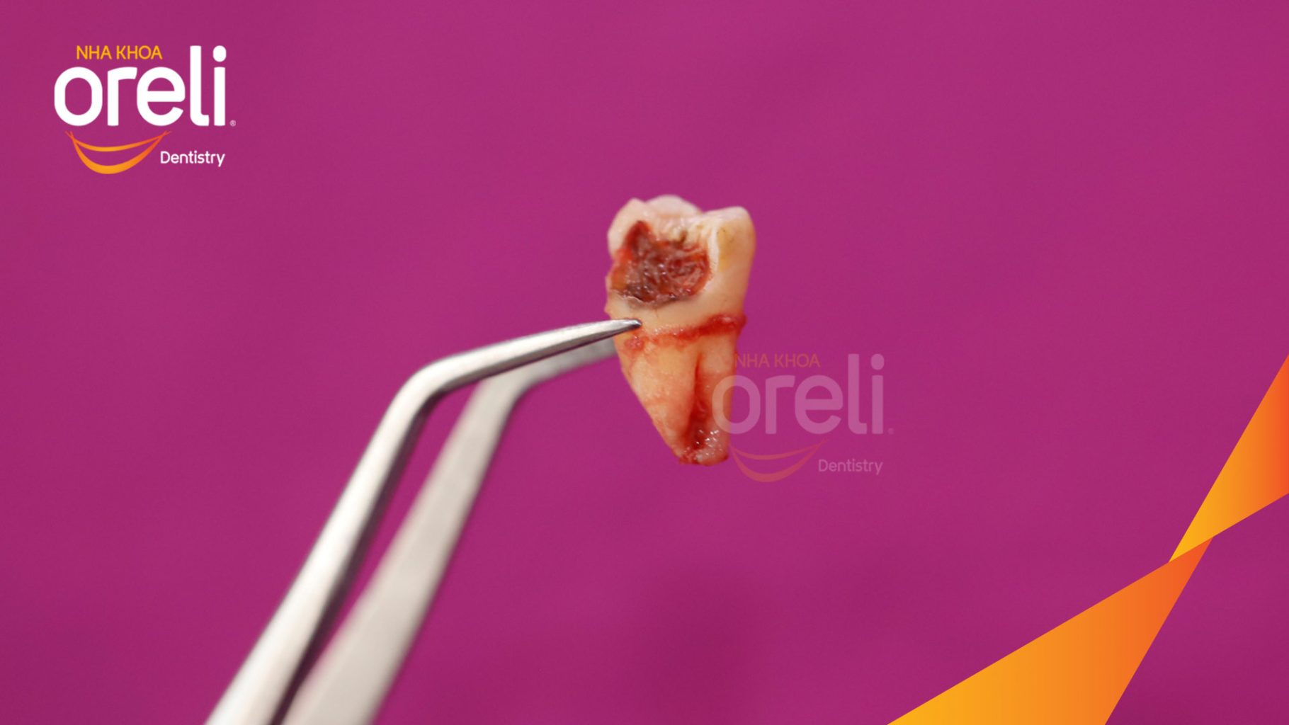Kết quả sau 45 phút: Loại bỏ răng khôn, ổ sâu viêm nhiễm tại Oreli