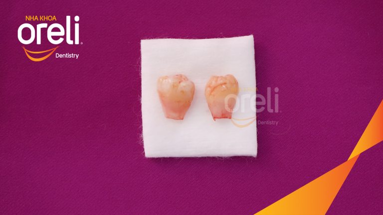 Ca Nhổ Răng Khôn Mọc Lệch Tại Buôn Ma Thuột | Nha khoa Oreli