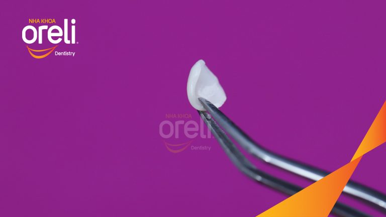 Dán sứ Veneer tại Buôn Ma Thuột | Nha khoa Oreli