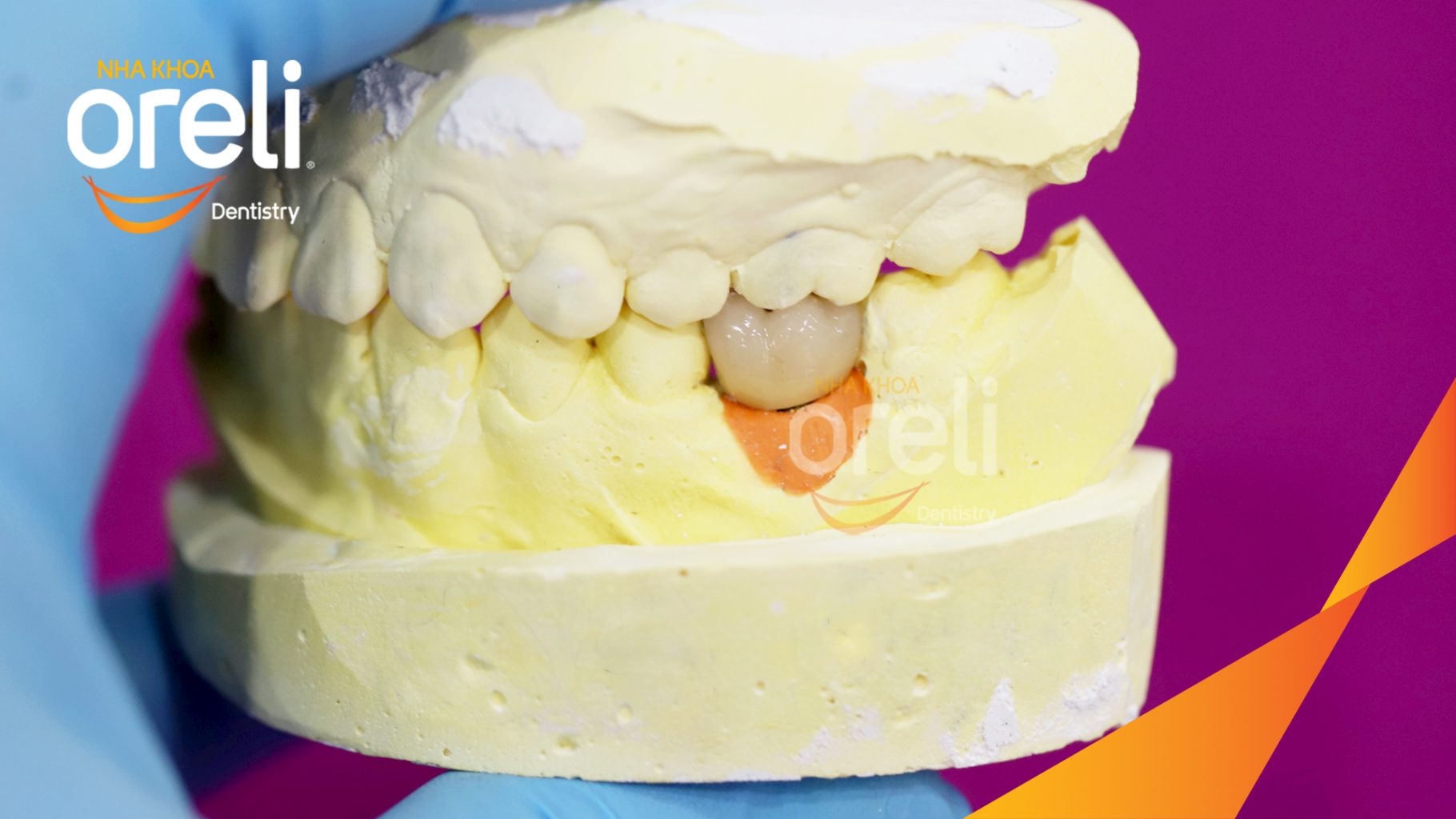 Kết quả sau 3 tháng: Phục hồi răng mất - ăn nhai chắc chắn và thẩm mỹ tự nhiên tại Oreli