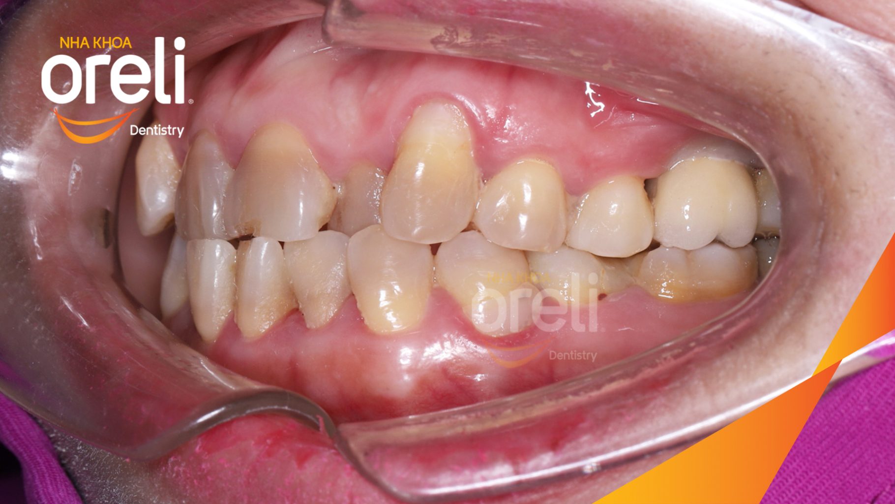 Kết quả đạt được sau 3 tháng - Phục hồi răng mất - ăn nhai chắc chắn và cười nói tự tin tại Oreli