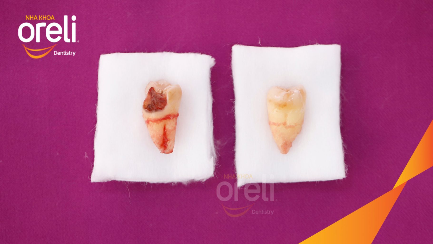 Quá trình Nhổ bỏ răng khôn hàm trên và dưới trong 45 phút tại Oreli