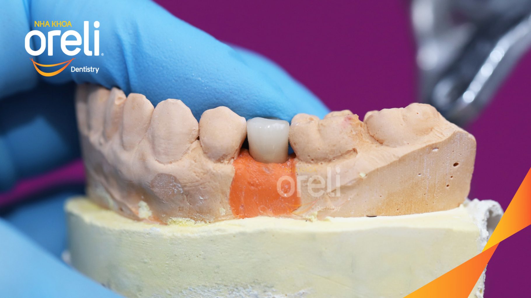 Thực hiện Tiến hành cấy trụ Implant chính hãng vào vùng mất răng kéo dài 3 tháng tại Oreli