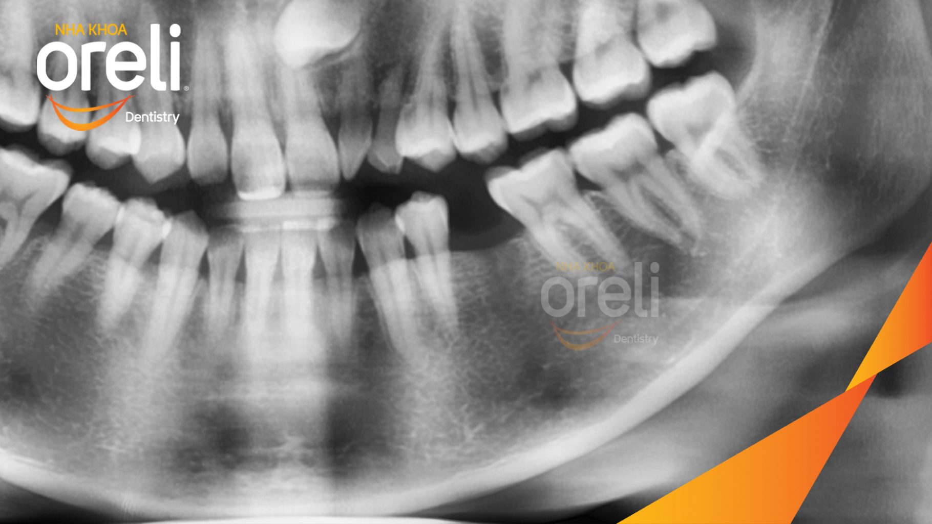 Trước điều trị: Mất răng hàm dưới thời gian dài tại Oreli