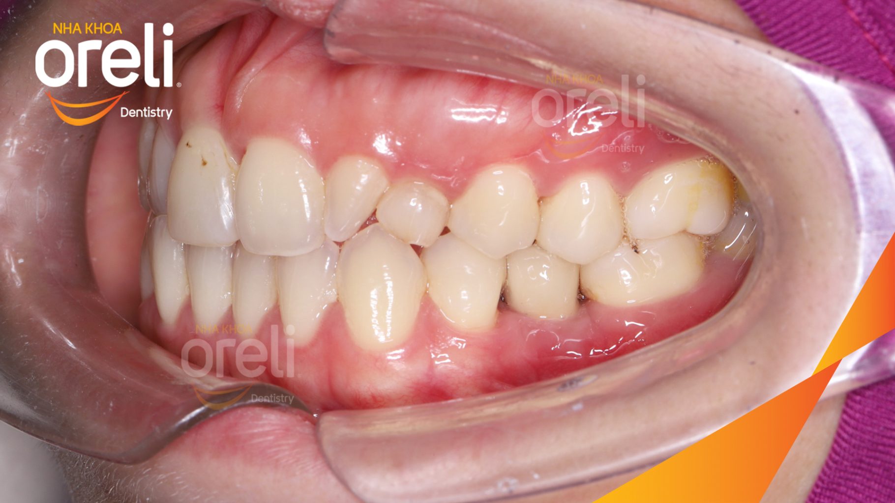 Quá trình Tiến hành cấy trụ Implant chính hãng vào vùng mất răng trong 3 tháng tại Oreli