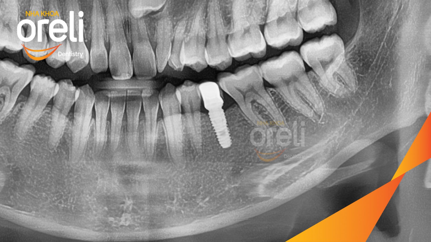 Mất răng hàm dưới thời gian dài trước khi điều trị tại Oreli