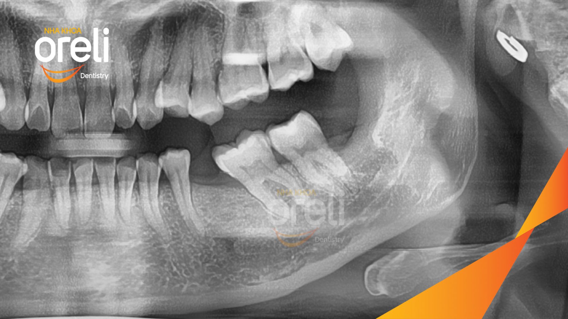 Thân răng chèn ép trực tiếp vào răng số 7 bên cạnh trước khi điều trị tại Oreli