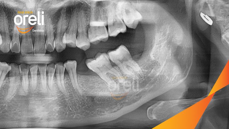 Nhổ răng khôn hàm dưới  – Case tại Oreli Buôn Ma Thuột