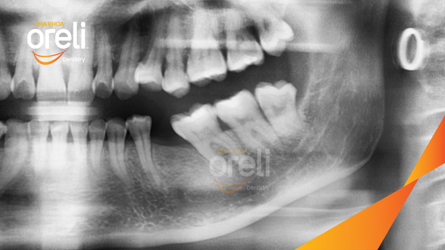 Trước điều trị: Thân răng chèn ép trực tiếp vào răng số 7 bên cạnh tại Oreli