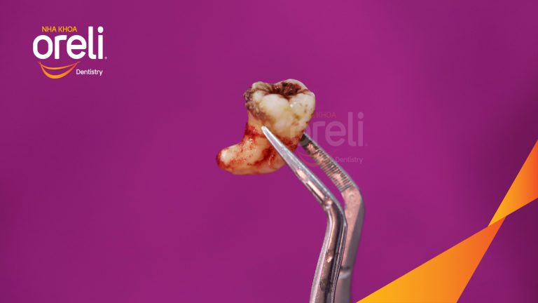 Nhổ răng khôn hàm dưới  – Case tại Oreli Buôn Ma Thuột