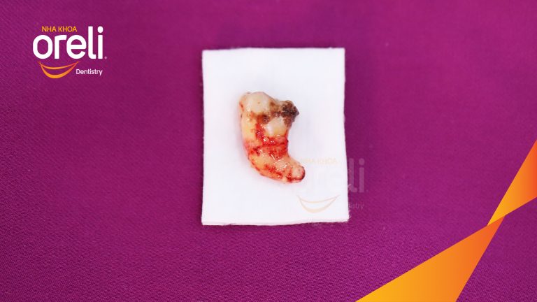 Nhổ răng khôn hàm dưới  – Case tại Oreli Buôn Ma Thuột