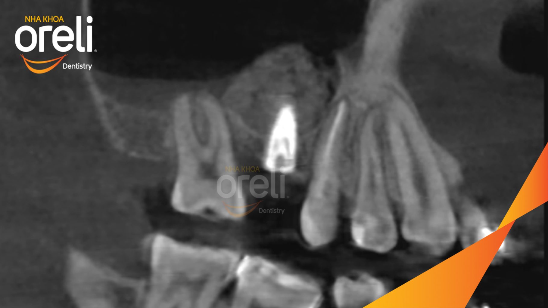 Mất răng hàm trên, xương hàm tiêu nhiều, chiều cao xương không đủ để đặt Implant trước khi điều trị tại Oreli