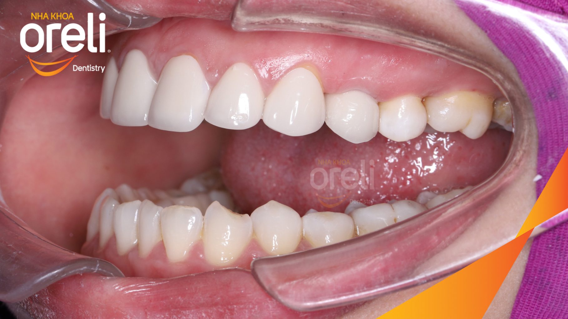 Kết quả đạt được sau 3 tháng - Phục hồi răng mất - ăn nhai chắc chắn và cười nói tự tin tại Oreli