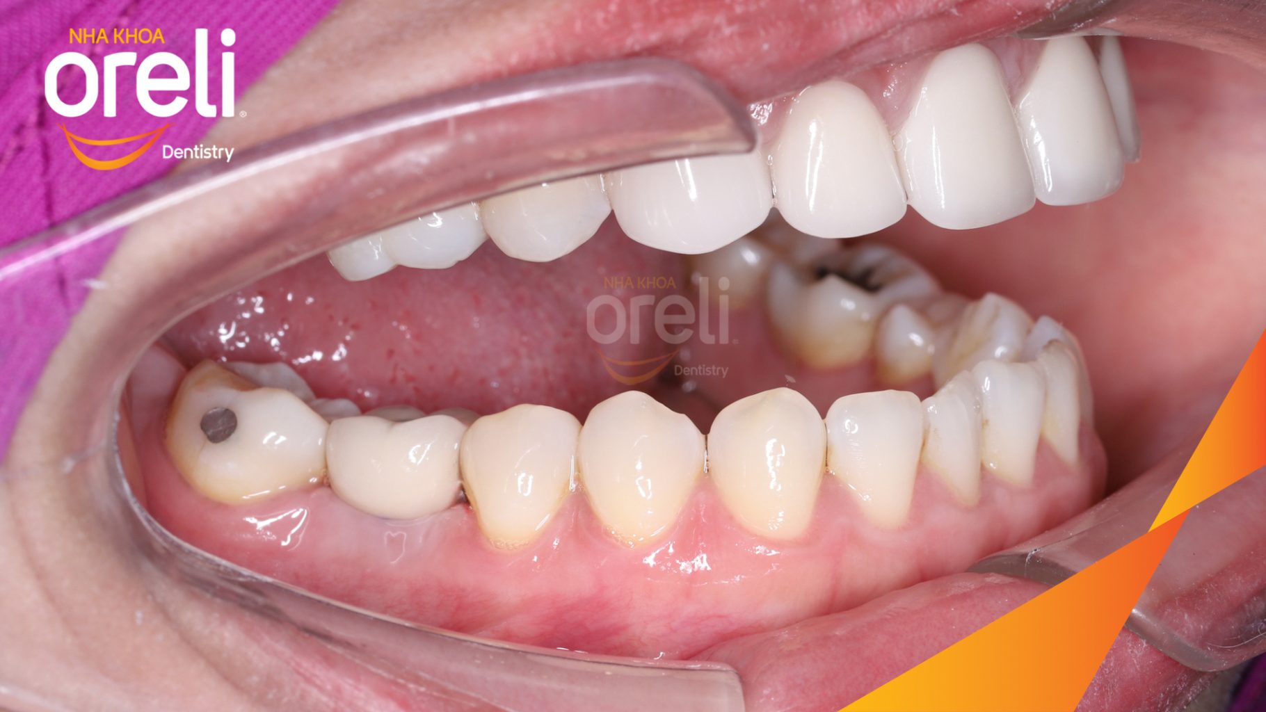 Kết quả sau 3 tháng: Phục hồi răng mất - ăn nhai chắc chắn và cười nói tự tin tại Oreli