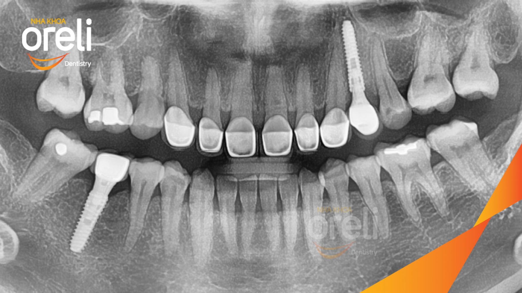 Thực hiện Tiến hành cấy ghép trụ Implant đúng vị trí mất răng, phục hình sứ trên Implant giúp khôi phục chức năng và thẩm mỹ kéo dài 3 tháng tại Oreli