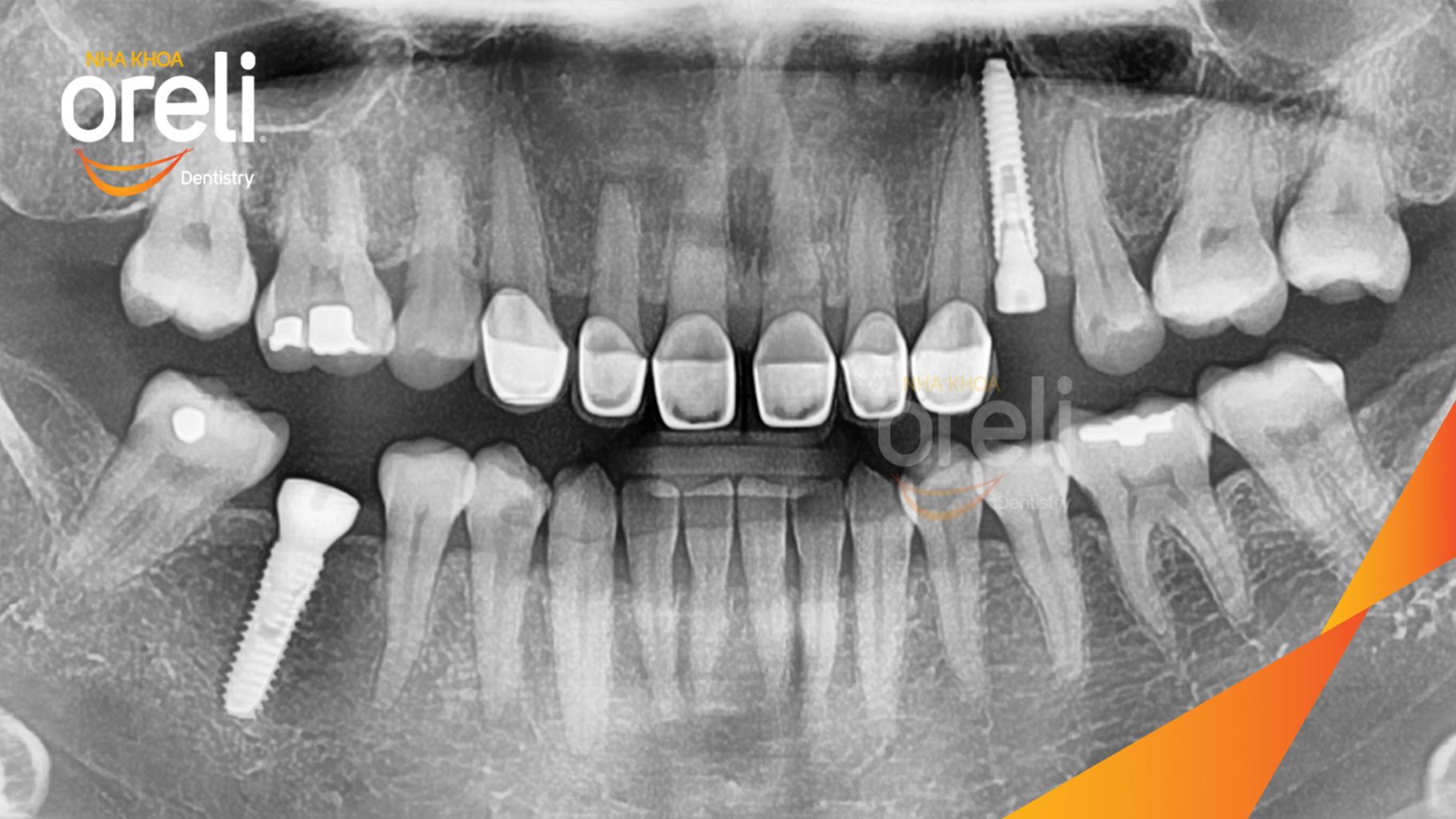 Mất răng hàm trên và dưới  trong thời gian dài, ảnh hưởng khả năng ăn nhai và khiến xương hàm tiêu dần theo thời gian trước khi điều trị tại Oreli