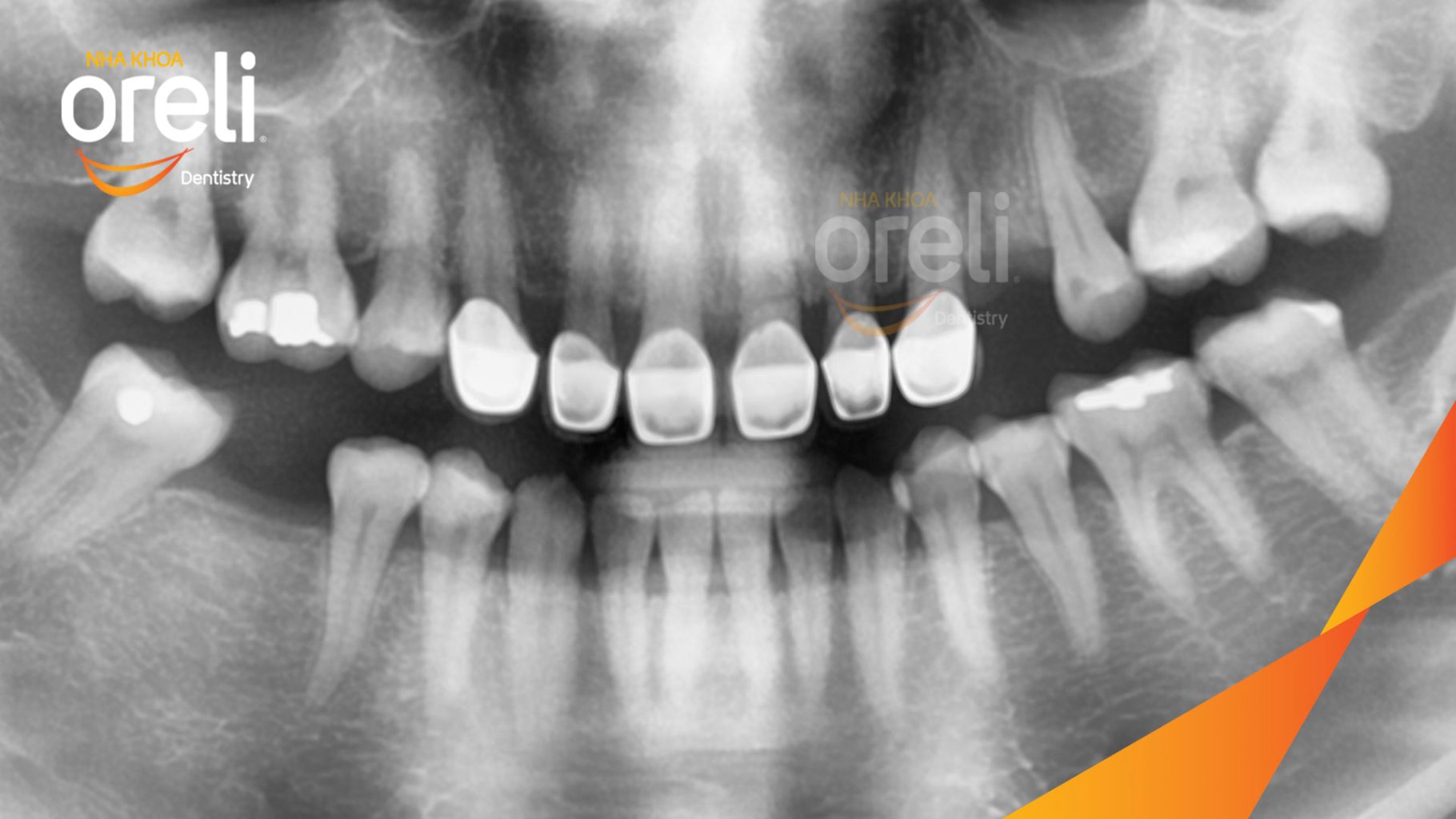 Trước điều trị: Mất răng hàm trên và dưới  trong thời gian dài, ảnh hưởng khả năng ăn nhai và khiến xương hàm tiêu dần theo thời gian tại Oreli