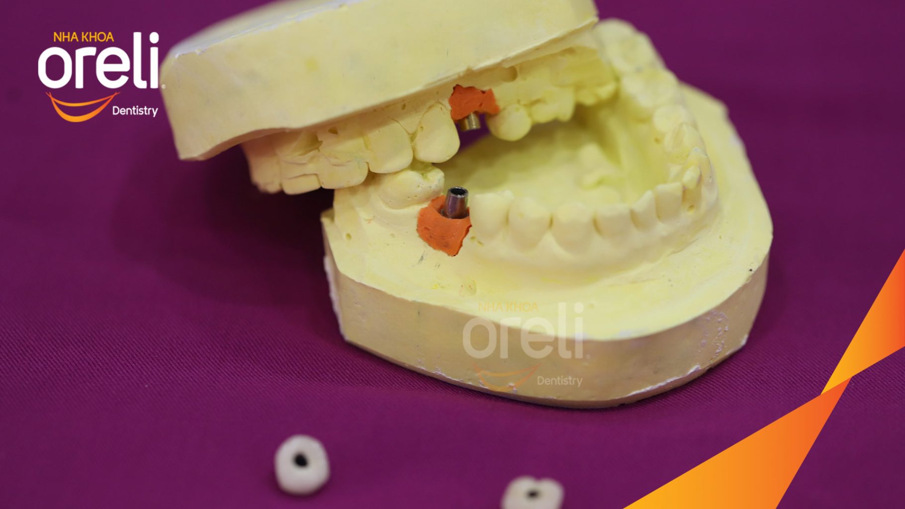 Quá trình Tiến hành cấy ghép trụ Implant đúng vị trí mất răng, phục hình sứ trên Implant giúp khôi phục chức năng và thẩm mỹ trong 3 tháng tại Oreli