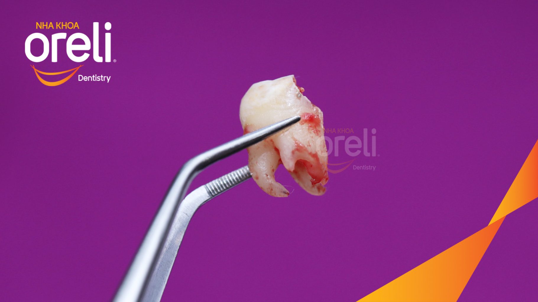 Kết quả đạt được sau 30 phút - Loại bỏ hoàn toàn răng khôn mọc ngầm hàm trên tại Oreli
