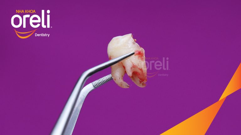 Ca Nhổ Răng Khôn Hàm Trên Tại Oreli