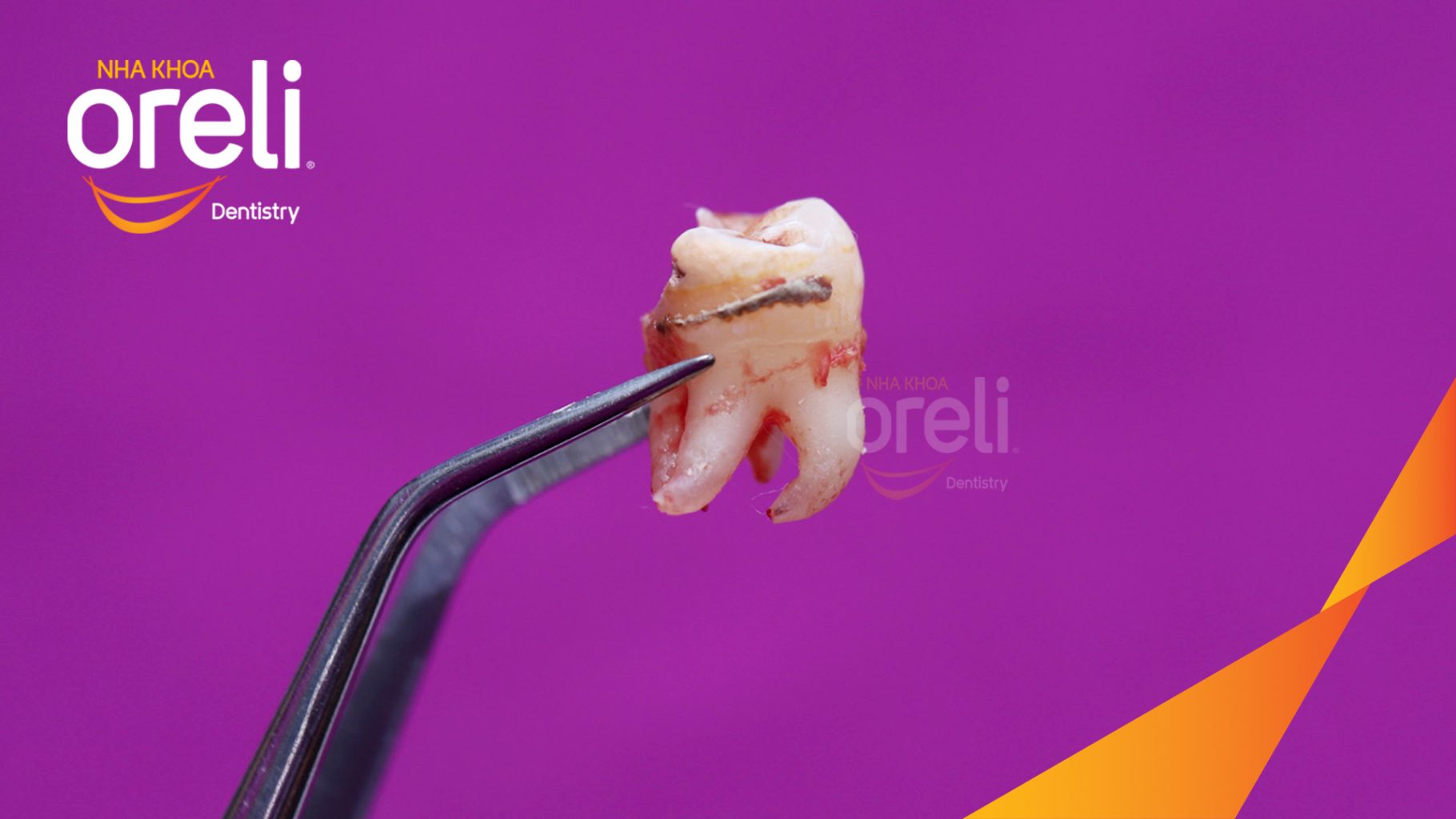 Kết quả sau 30 phút: Loại bỏ hoàn toàn răng khôn mọc ngầm hàm trên tại Oreli