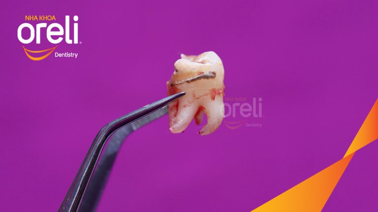 Ca Nhổ Răng Khôn Hàm Trên Tại Oreli