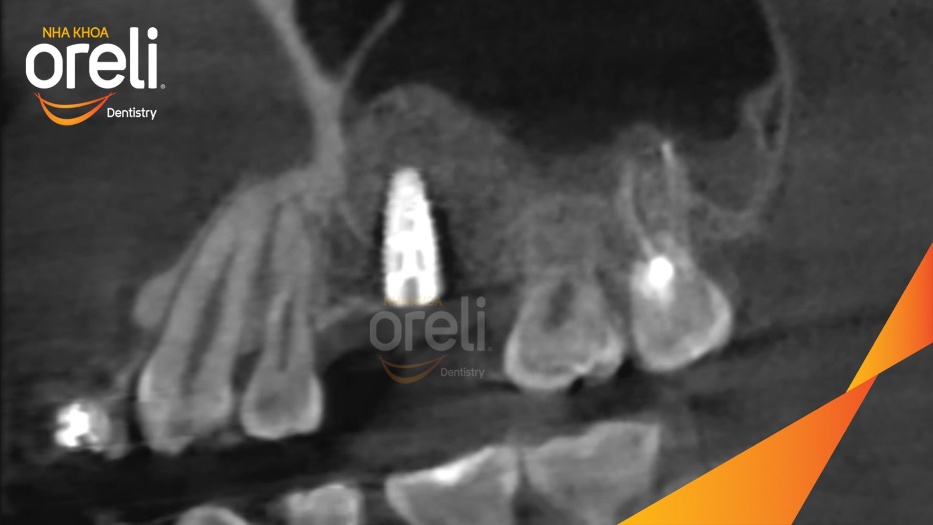Kết quả đạt được sau 6 tháng - Hoàn thành nâng xoang và đặt trụ Implant đúng vị trí mất răng tại Oreli