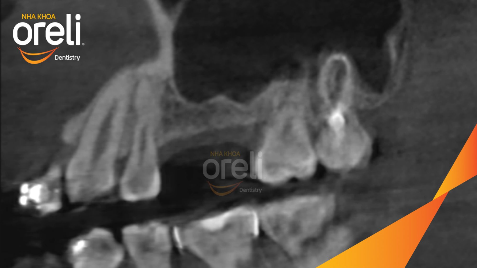 Kết quả sau 6 tháng: Hoàn thành nâng xoang và đặt trụ Implant đúng vị trí mất răng tại Oreli