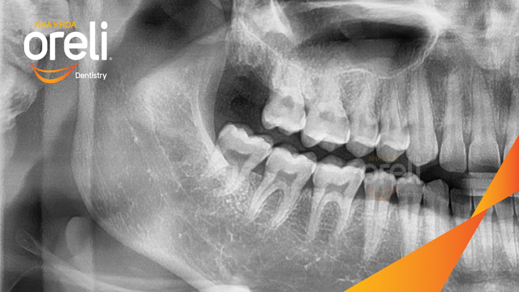 Răng khôn gây đau nhức kéo dài  trước khi điều trị tại Oreli