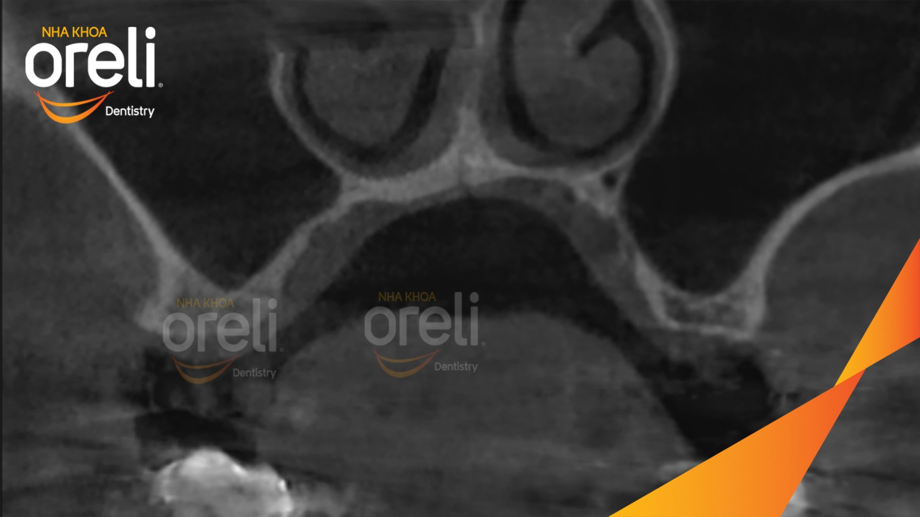 Quá trình Thực hiện nâng xoang hở để tăng thể tích xương vùng mất răng. Cấy trụ Implant chính hãng vào vùng mất răng trong 6 tháng tại Oreli