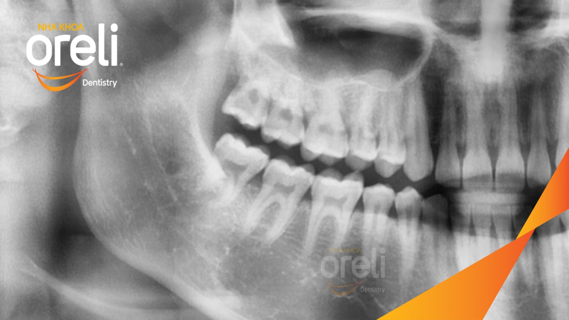 Trước điều trị: Răng khôn gây đau nhức kéo dài  tại Oreli