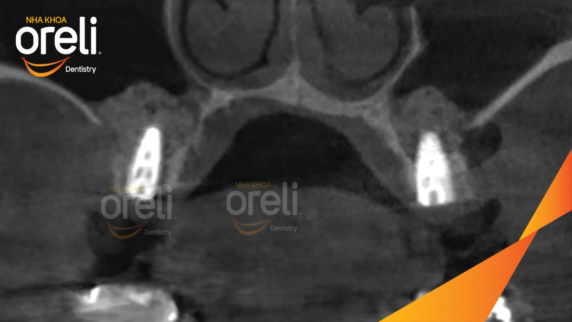 Thực hiện Thực hiện nâng xoang hở để tăng thể tích xương vùng mất răng. Cấy trụ Implant chính hãng vào vùng mất răng kéo dài 6 tháng tại Oreli