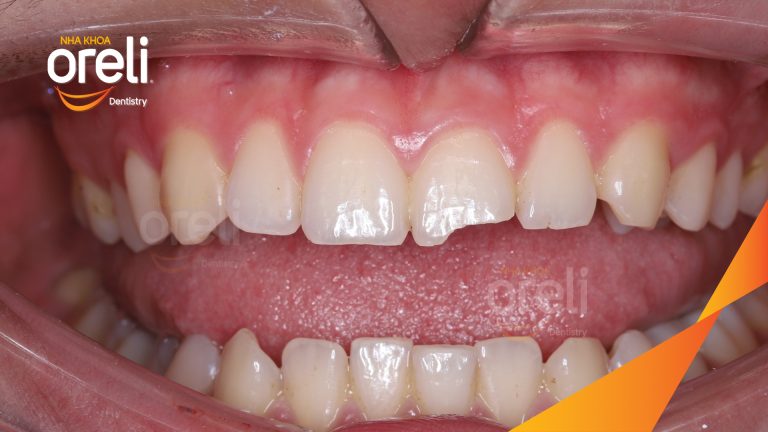 Mẻ răng cửa phục hồi bằng mặt dán sứ veneer kết quả thực tế | Nha khoa Oreli