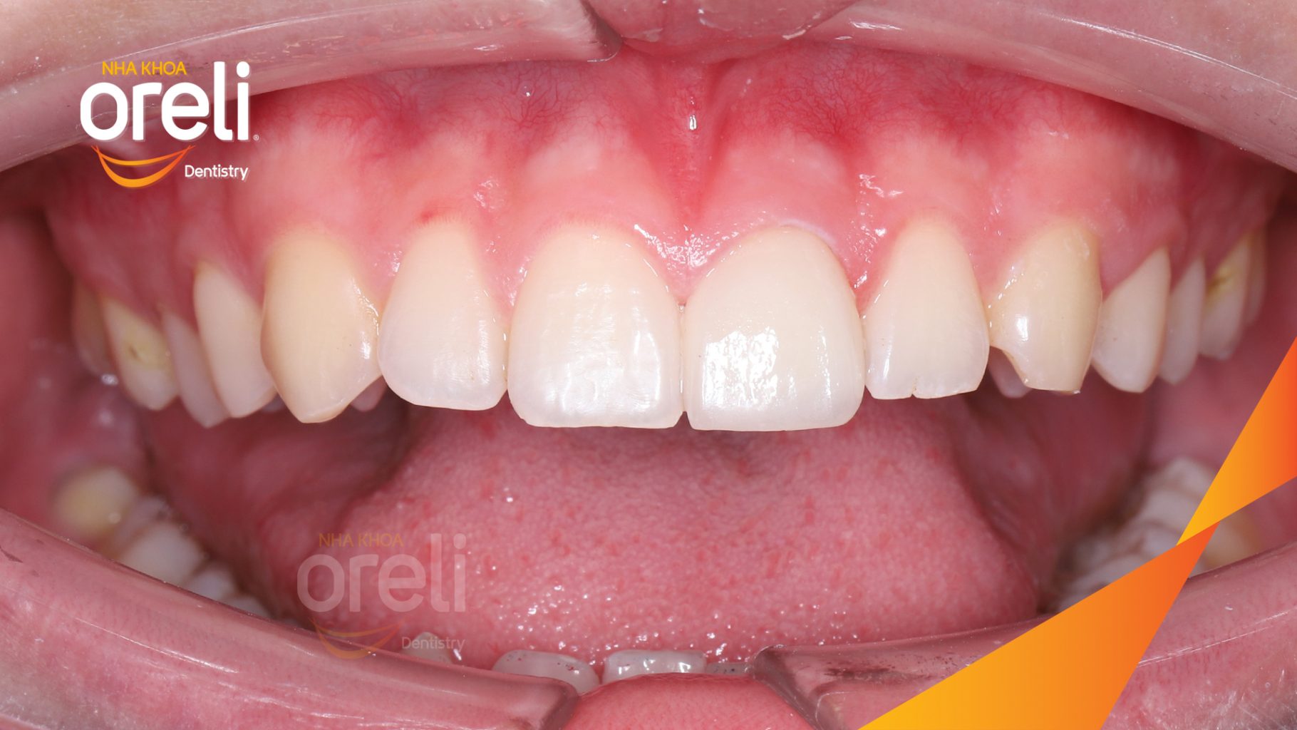Thực hiện Dán sứ veneer kéo dài 2 lần hẹn tại Nha khoa Oreli