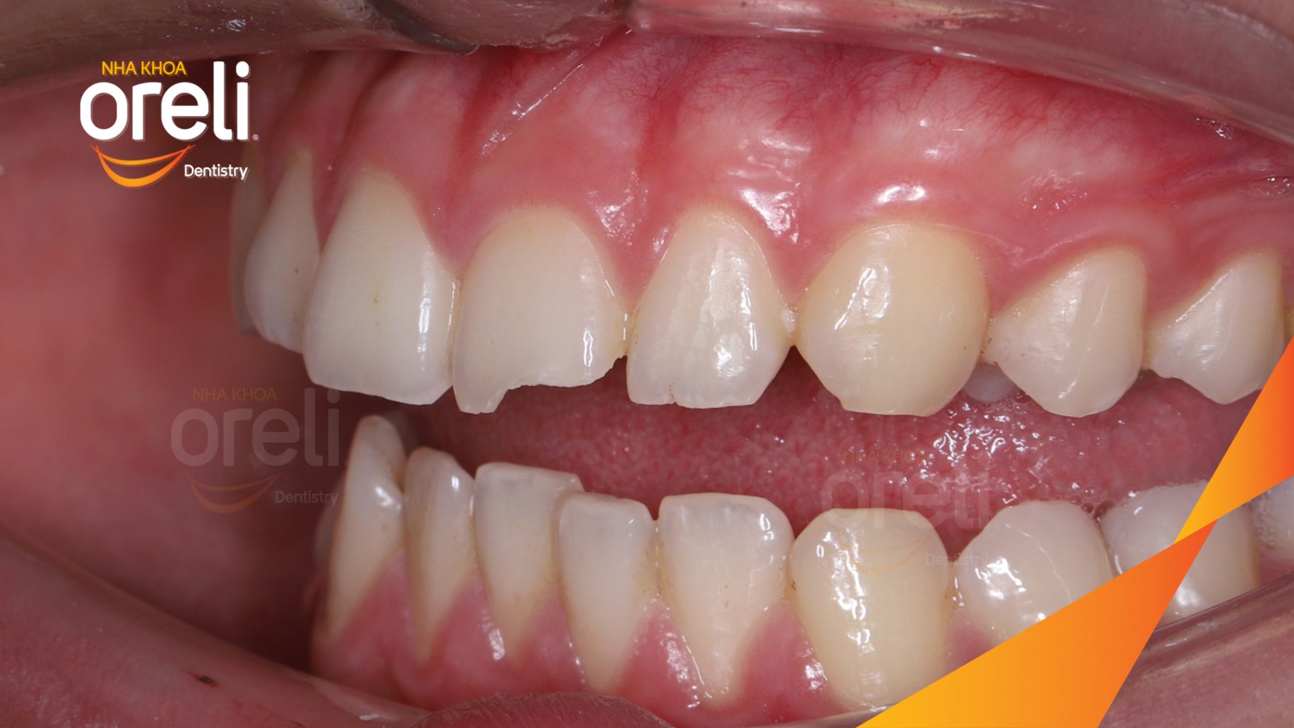 Kết quả sau 2 lần hẹn: Phục hồi sứt mẻ tương đương răng thật tại Nha khoa Oreli