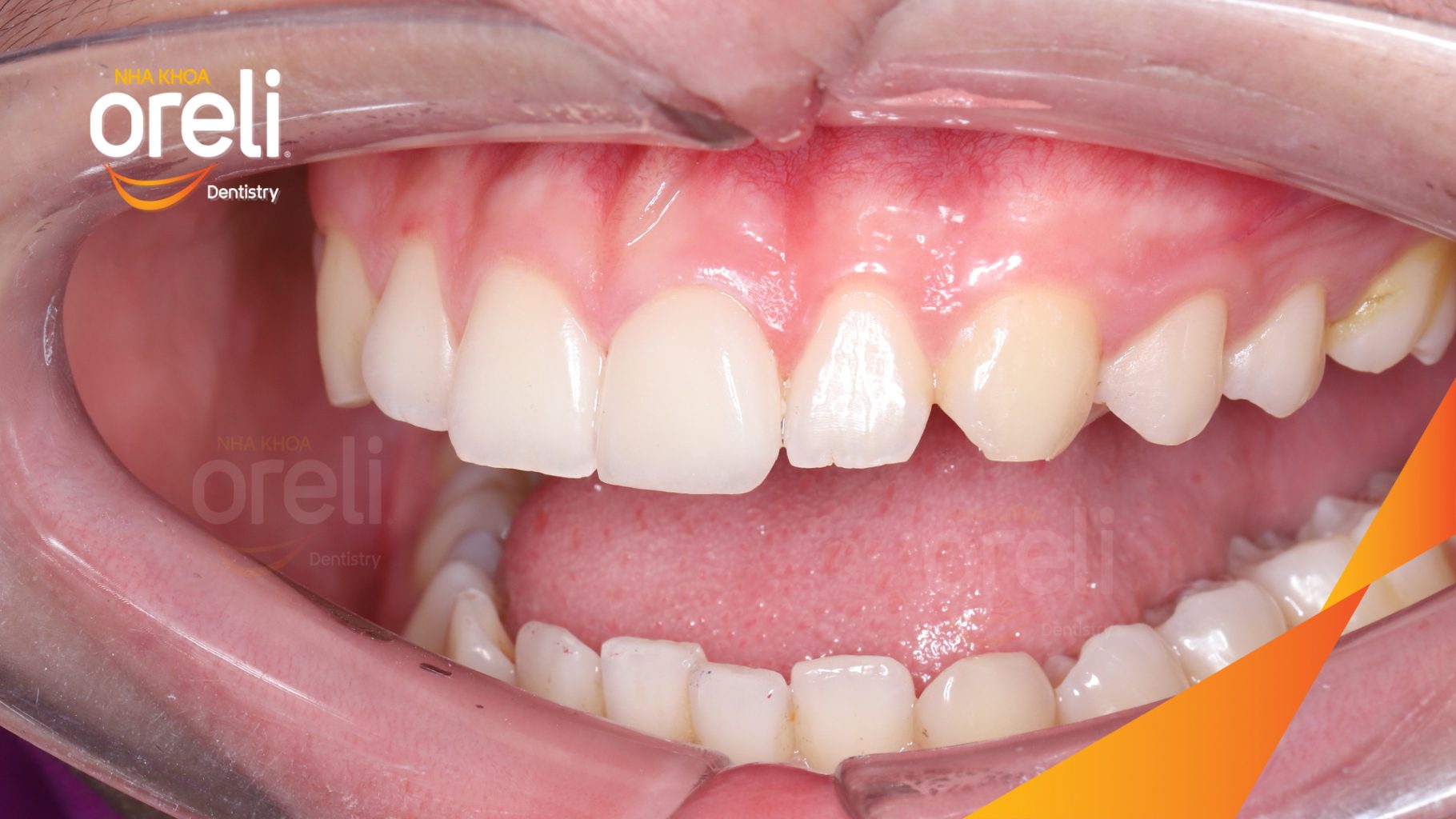 Kết quả đạt được sau 2 lần hẹn - Phục hồi sứt mẻ tương đương răng thật tại Nha khoa Oreli