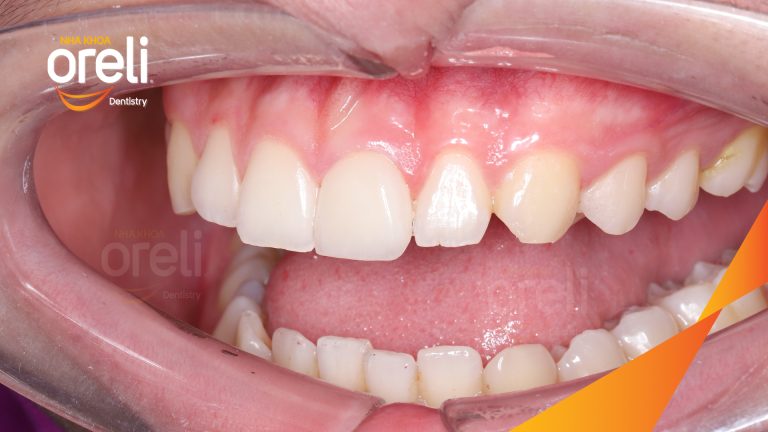 Mẻ răng cửa phục hồi bằng mặt dán sứ veneer kết quả thực tế | Nha khoa Oreli