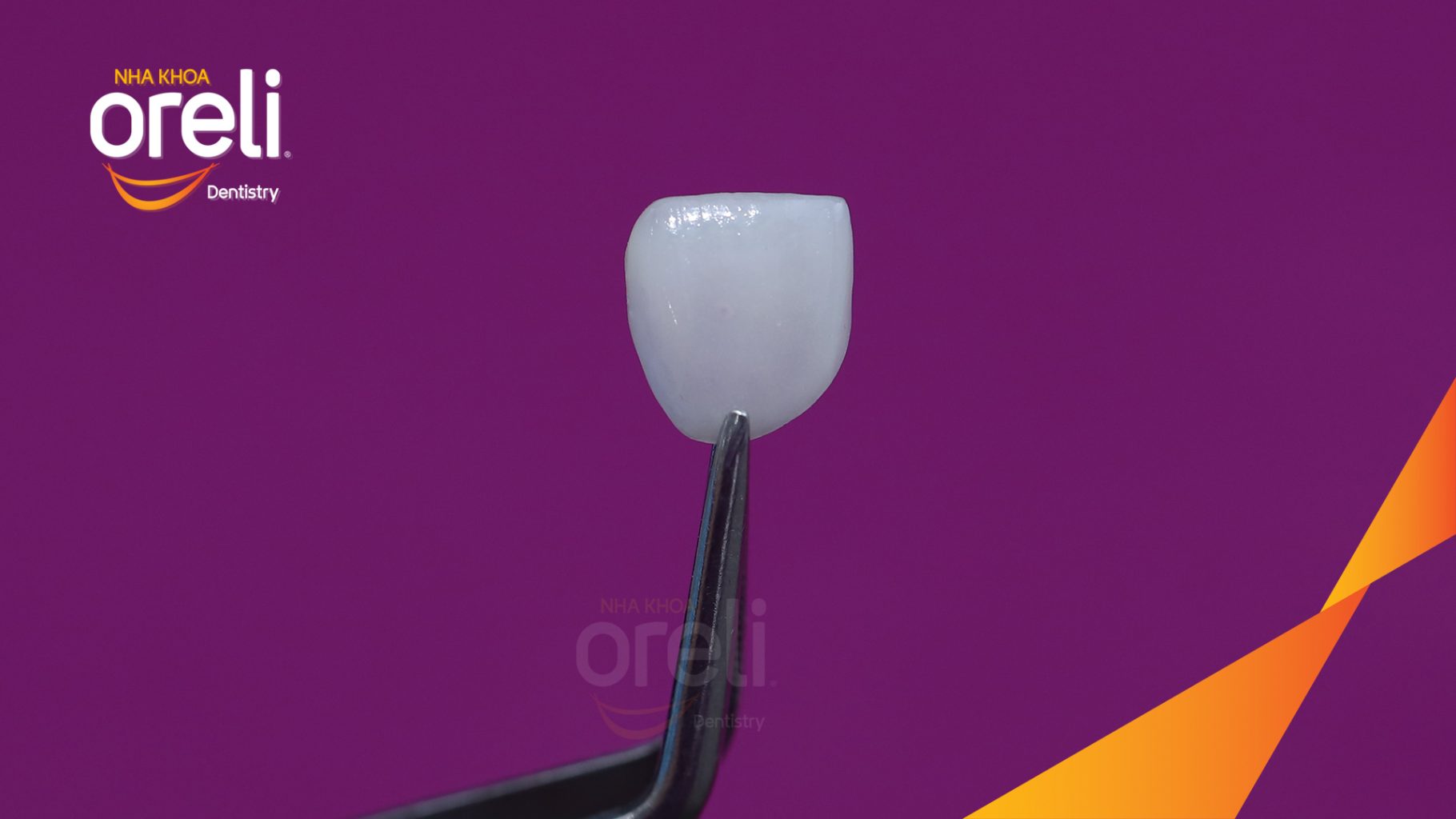 Trước điều trị: Răng cửa giữa số 21 bị vỡ mẻ rìa cắn tại Nha khoa Oreli