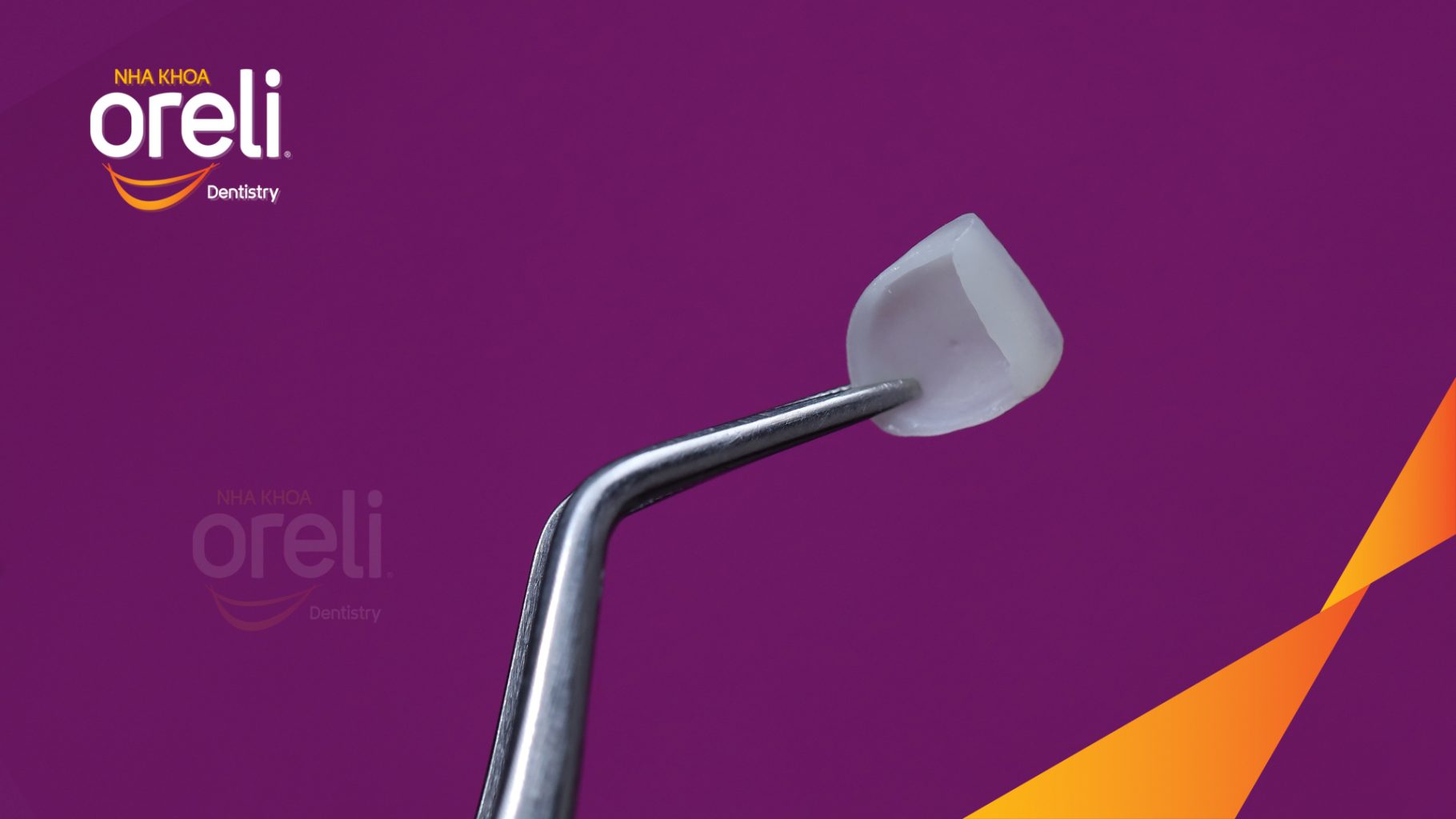 Trước điều trị: Răng cửa giữa số 21 bị vỡ mẻ rìa cắn tại Nha khoa Oreli
