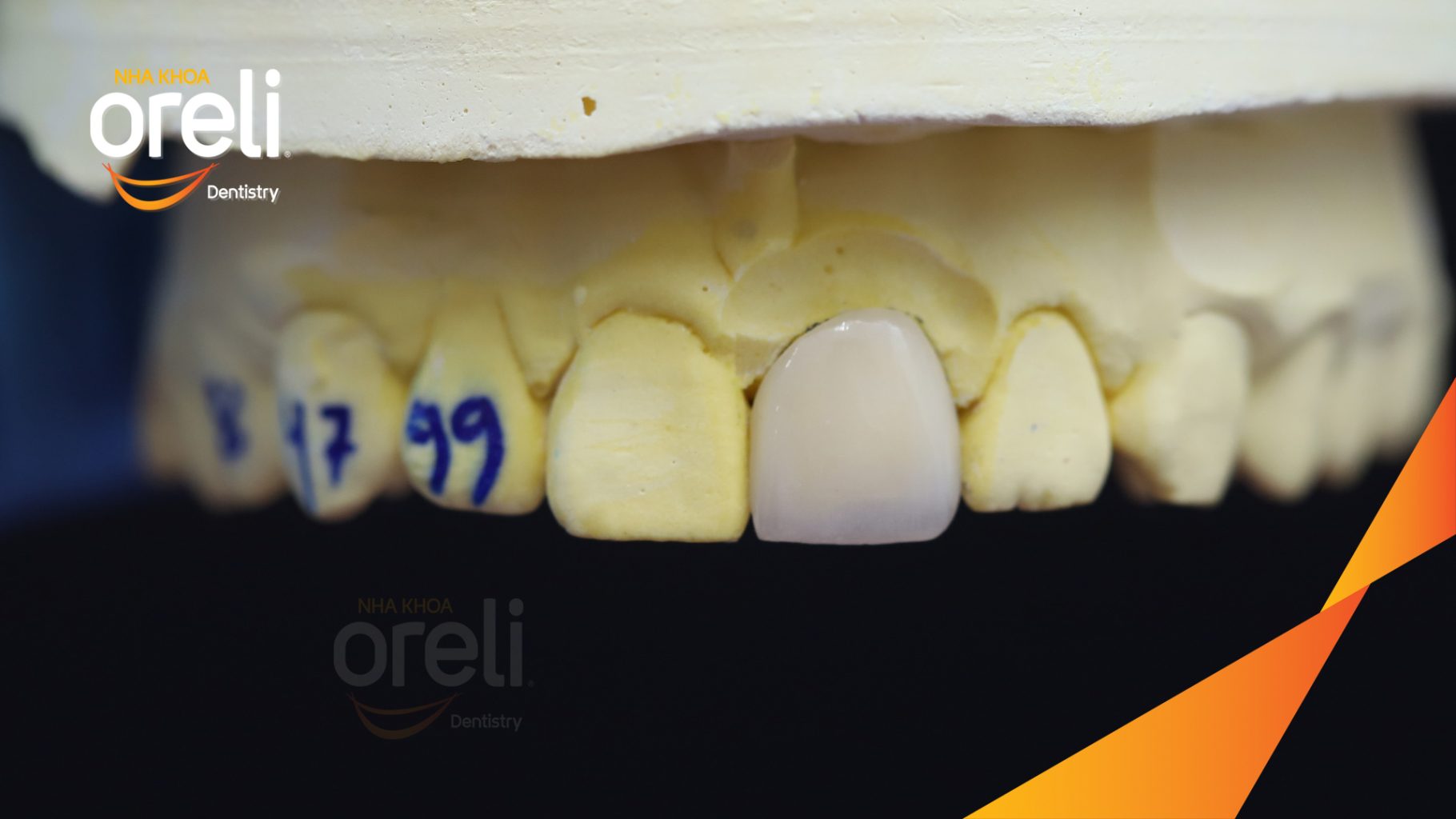 Răng cửa giữa số 21 bị vỡ mẻ rìa cắn trước khi điều trị tại Nha khoa Oreli