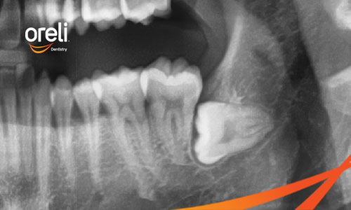 Răng Khôn Mọc Lệch Nguy Hiểm Thế Nào? Khi Nào Cần Nhổ Răng Khôn?