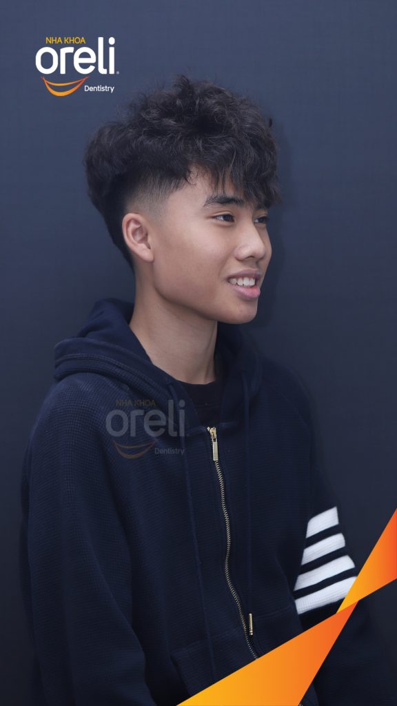 Kết quả đạt được sau 2 năm - Khớp cắn đều đẹp nụ cười hài hòa tại Nha khoa Oreli