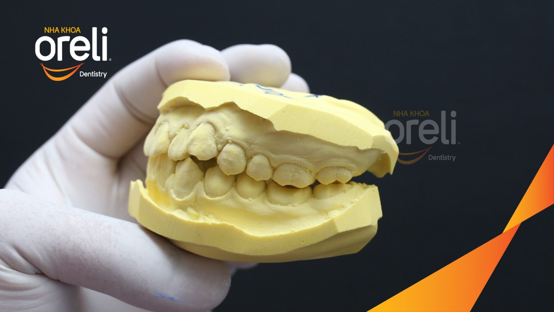 Thực hiện Chỉnh nha mắc cài kim loại không nhổ răng kéo dài 2 năm tại Nha khoa Oreli