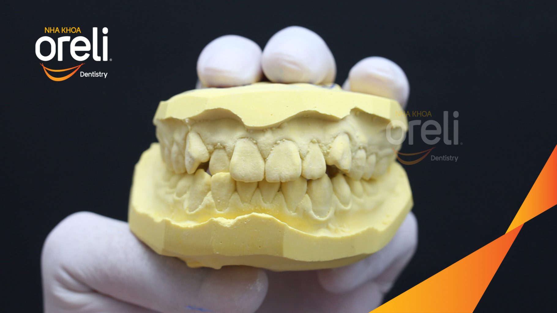 Trước điều trị: Chen chúc hai hàm, cắn ngược răng cửa bên tại Nha khoa Oreli