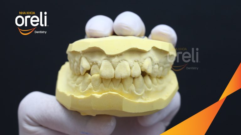 Ca niềng răng chen chúc không nhổ răng kết quả trước sau | Nha khoa Oreli