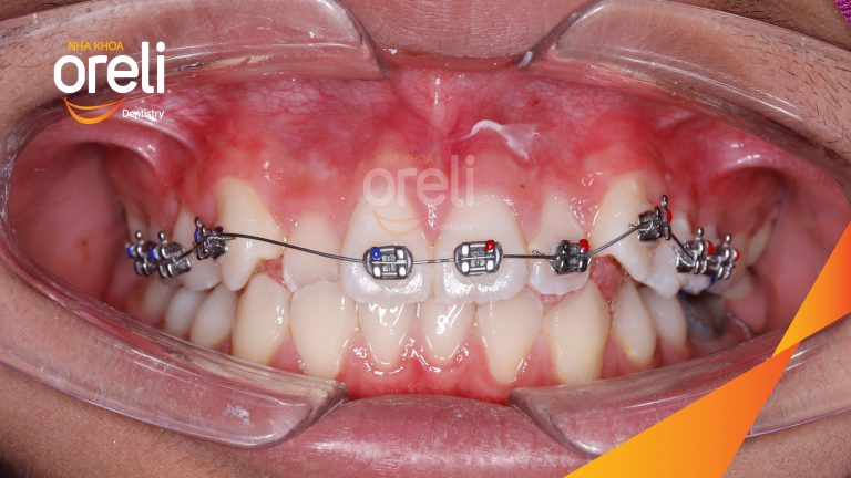 Ca niềng răng chen chúc không nhổ răng kết quả trước sau | Nha khoa Oreli