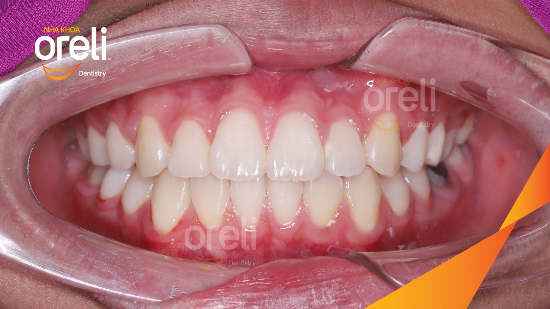Thực hiện Chỉnh nha mắc cài kim loại không nhổ răng kéo dài 2 năm tại Nha khoa Oreli
