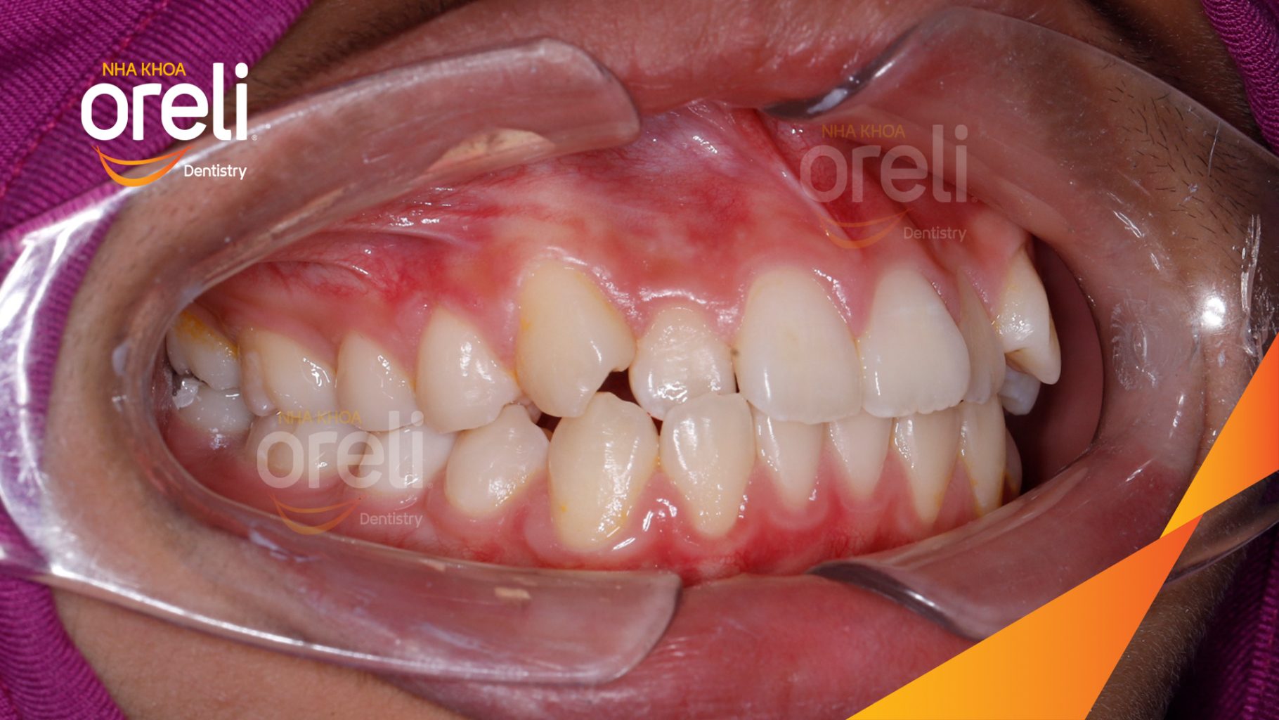 Kết quả sau 2 năm: Khớp cắn đều đẹp nụ cười hài hòa tại Nha khoa Oreli