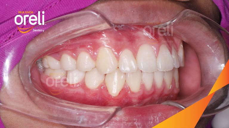 Ca niềng răng chen chúc không nhổ răng kết quả trước sau | Nha khoa Oreli